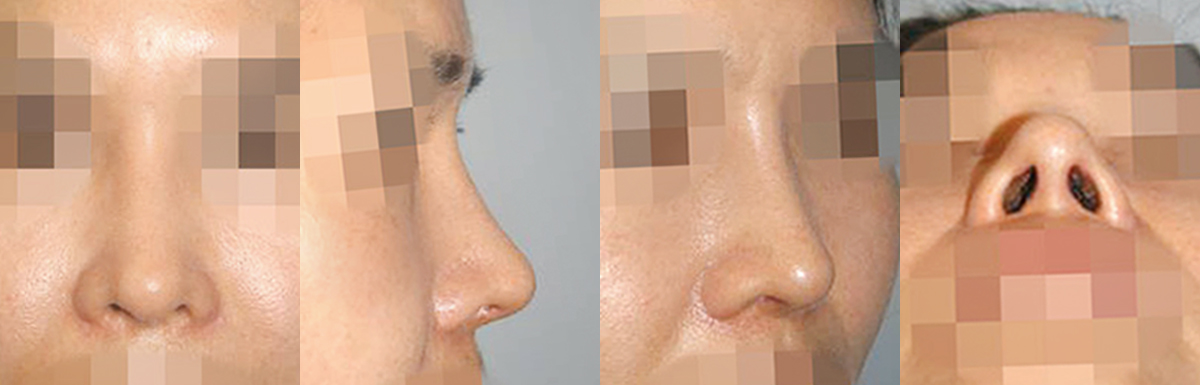 caseA_before