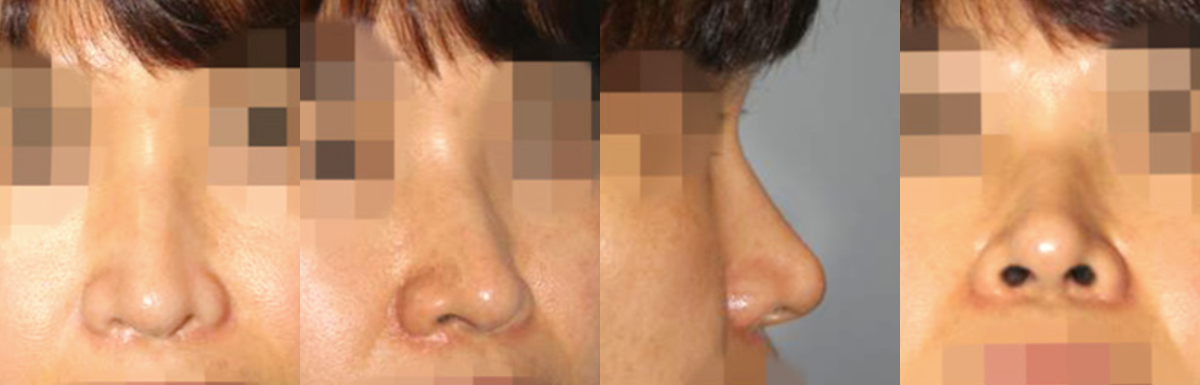 caseA_before