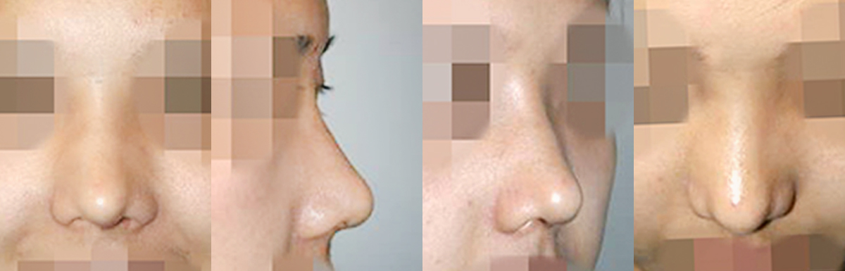 caseA_before